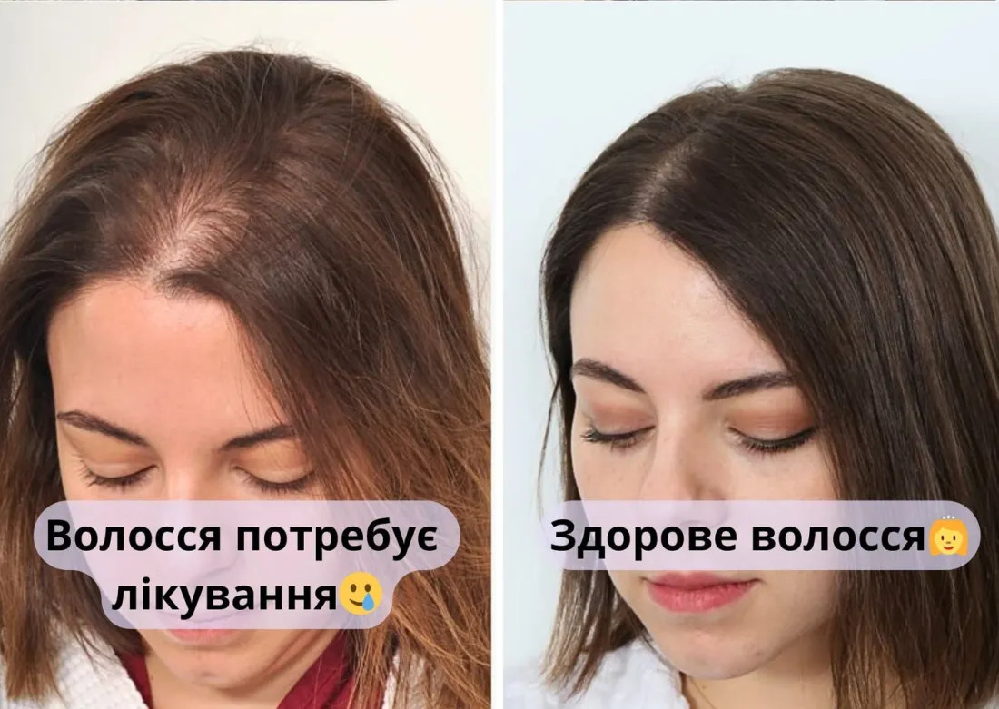 Результат: залисини біля чола заповнились